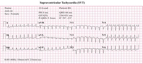 Atrial Tachycardia - Causes, Symptoms, Diagnosis, Treatment