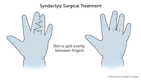 Syndactyly | Boston Children's Hospital