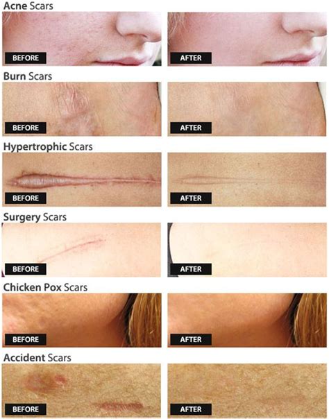 Dermefface FX7™ by Skinception™ fades scars and makes skin vibrant and ...