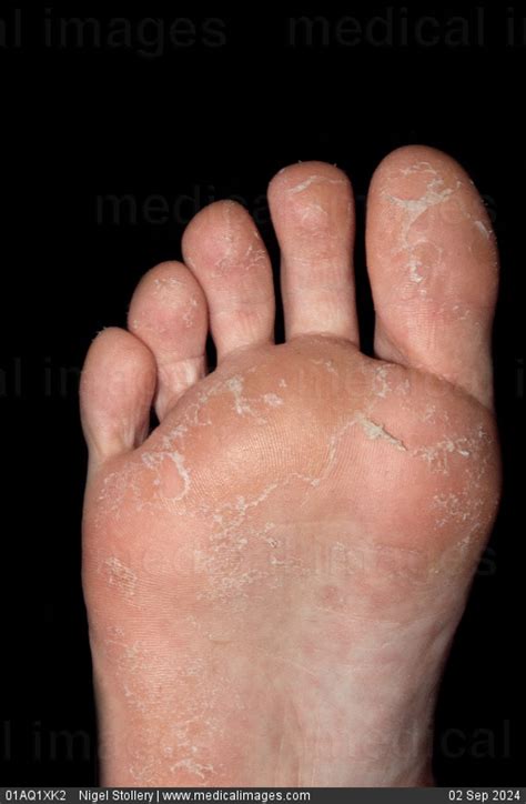 STOCK IMAGE, juvenile plantar dermatosis on the foot of an eleven year old female patient ...