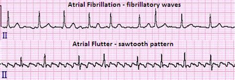 Pin on Atrial Flutter