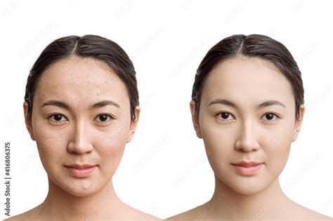 the concept of skin care before, after. young asian woman with bad skin ...