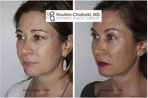 Cheek Augmentation with Fillers