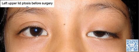 Congenital Ptosis | ROQUE Eye Clinic | Eye.com.ph