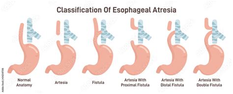 Esophageal atresia types set. Congenital medical condition of trachea Stock Vector | Adobe Stock