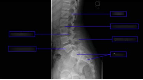 Sacrum Xray Diagram | Quizlet