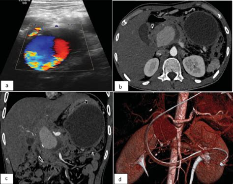 (a) Ultrasound with color Doppler showing large pseudoaneurysm with... | Download Scientific Diagram