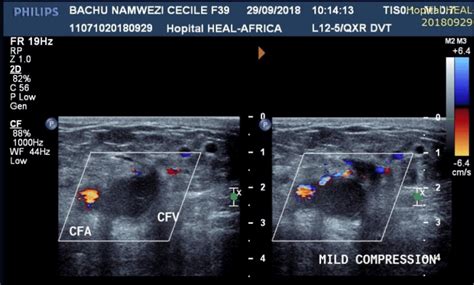 Duplex ultrasound in upper and lower limb deep venous thrombosis