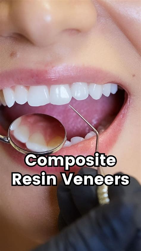 The pros and cons of composite resin dental veneers [Video] | Dental ...