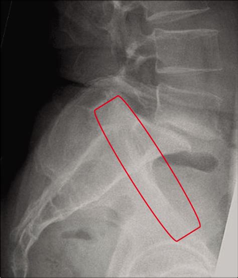 Iliopectineal line: A valuable radiological reference for spino-pelvic parameters - Journal of ...