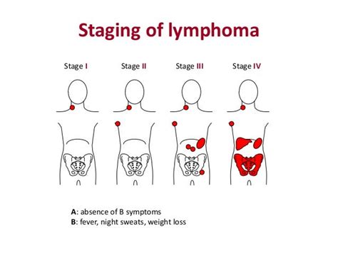 Follicular lymphoma