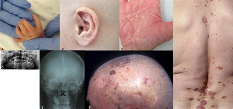 Manifestations of Gorlin-Goltz syndrome. | Semantic Scholar