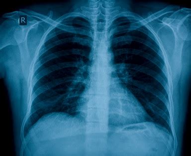 Chest Pain Test – Heart and Lung X-Ray, ECG Stress Tests | Healthhype.com