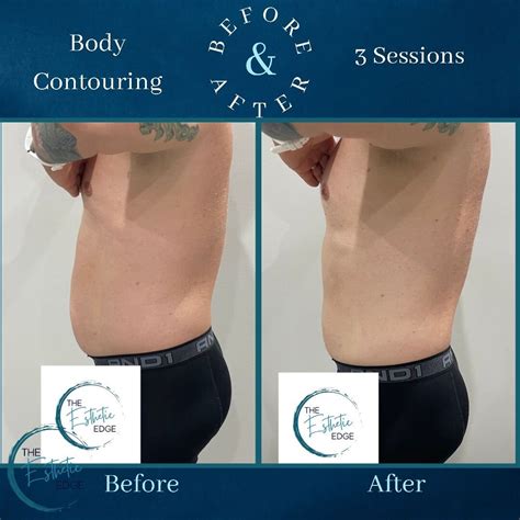 Before and After Body Contouring Photos — Louisville Lymphatic Center