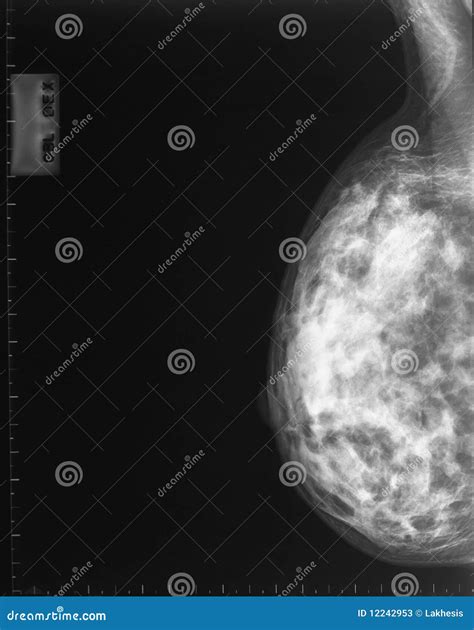 X-ray Mammogram Stock Photos - Image: 12242953