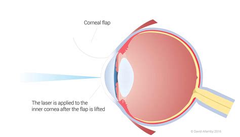 How Does Laser Eye Surgery Work? | Focus Clinics