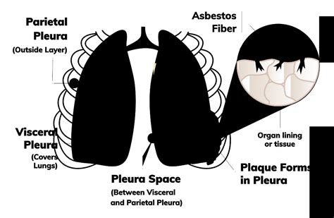 Pleural Thickening Symptoms, Causes And Treatment, 48% OFF