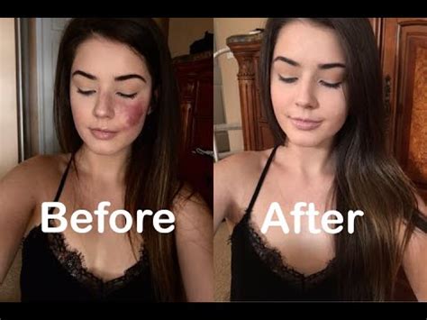 How I Cover My Port Wine Stain Birthmark - YouTube