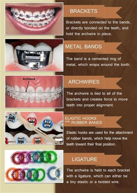 Dentaltown - Common braces and orthodontic terms and what they mean ...