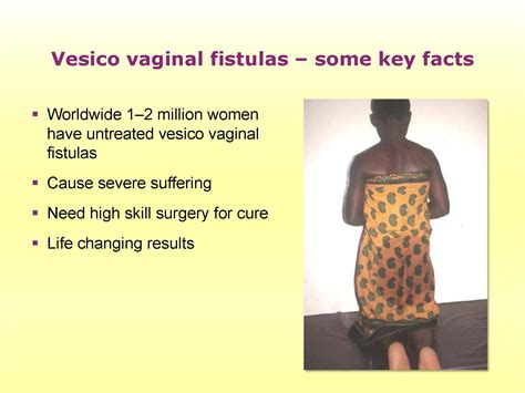 Obstetric Fistula | Tutorial | GLOWM