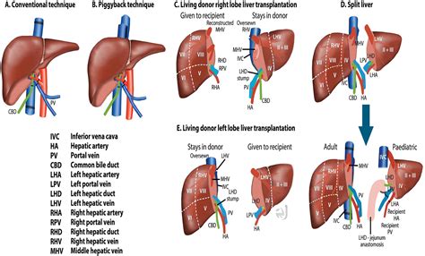 Nonvascular Post–Liver Transplantation Complications: From US Screening to Cross-sectional and ...