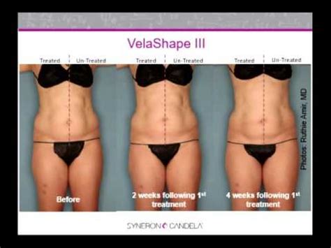 Dr. Patrick Treacy: Velashape 3 RF Non Surgical Body Contouring Device ...