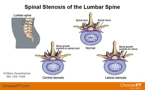 Guide | Physical Therapy Guide to Spinal Stenosis | Choose PT