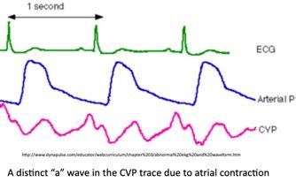 Online Central Venous Pressure (CVP) Course | IvyLeagueNurse