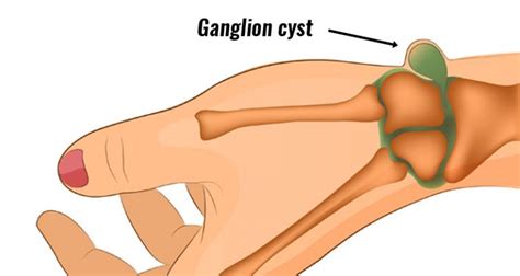 Ganglion cyst - Symptoms, Causes, Treatment and Surgery