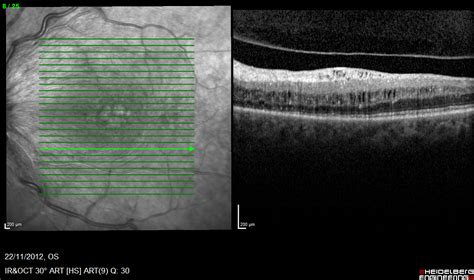 Diabetic retinopathy screening