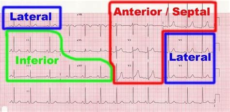 Infarct location per lead on the ECG | Ekg interpretation, Critical care nursing, Ekg