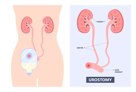 A Quick Guide to Urostomy Basics - United Ostomy Associations of America