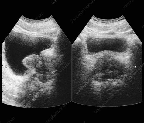 Enlarged prostate, ultrasound scan - Stock Image - M865/0214 - Science Photo Library