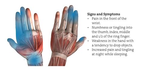 Carpal Tunnel Syndrome (CTS) In The Workplace - Healthscreen UK