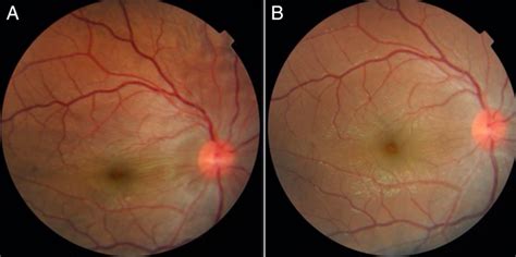 Posterior scleritis presenting as conjunctivitis in a child | BMJ Case ...