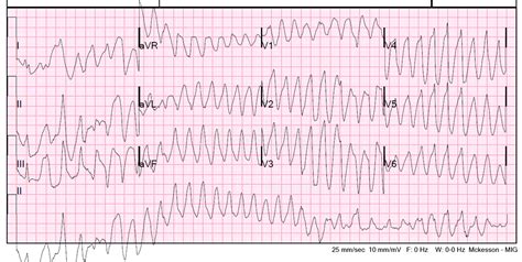 Dr. Smith's ECG Blog: Polymorphic Ventricular Tachycardia