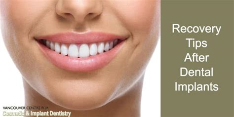 Our Top Tips for a Smooth Recovery after Getting Dental Implants | VCCID