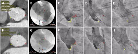 Cusp-overlap technique during TAVI using the self-expanding Portico FlexNav system | Revista ...