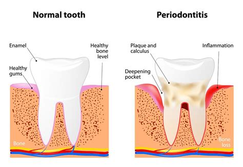 Pocket Reduction Surgery Meridian, MS - Laurel, MS - Hattiesburg, MS ...