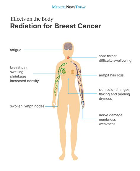 Side effects of radiation for breast cancer: What to know