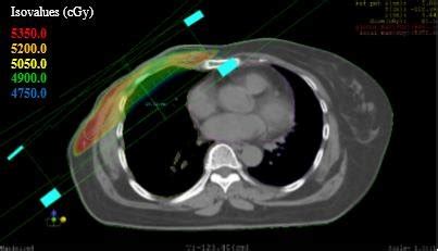 Radiotherapy treatment planning for breast cancer patients with ...