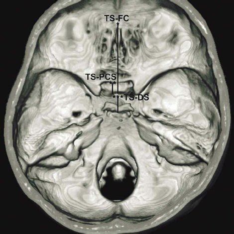 The distance between the tuberculum sellae and dorsum sellae (TS–DS),... | Download Scientific ...