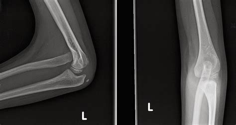 Congenital Radial Head Dislocations: Elbow or forearm problem? | Congenital Hand and Arm ...