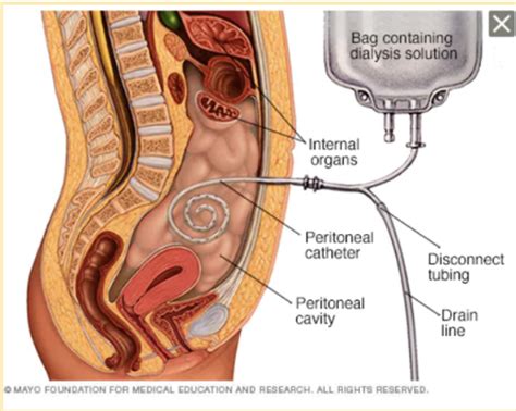 La diálisis peritoneal