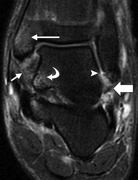 Deltoid Ligament Ultrasound