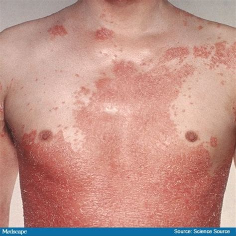 Fast Five Quiz: Psoriasis Types - Page 5