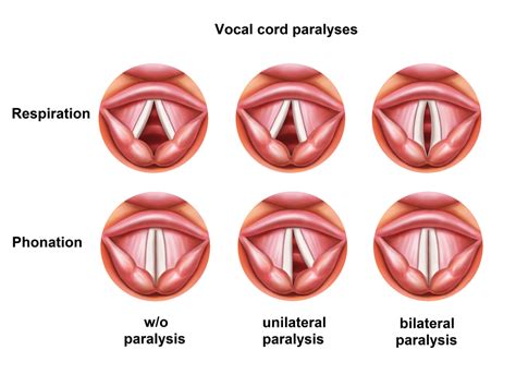 Is VCD An Allergic Response