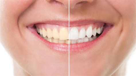 Five experts explain: Is whitening bad for your teeth? - NZ Herald