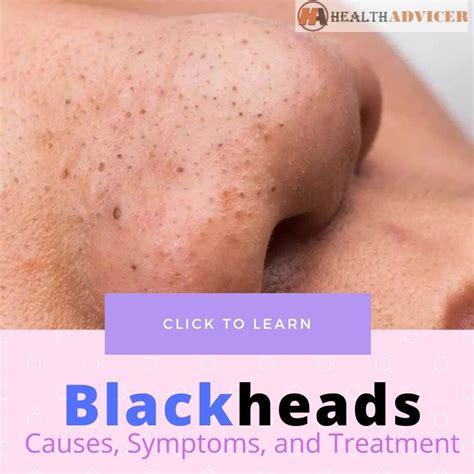 Blackheads: Causes, Symptoms, Diagnosis And Treatment