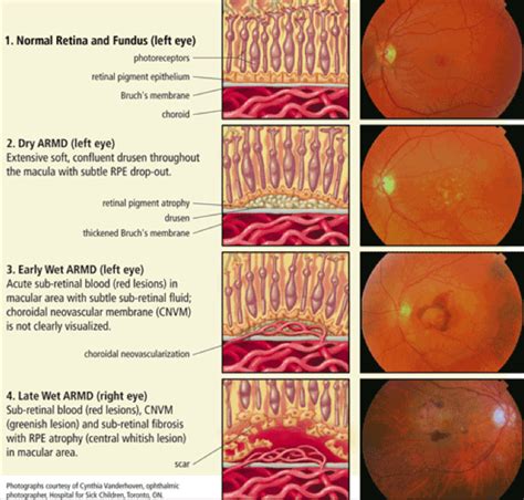 Classification of ARMD. a repin from Piedmont Eye Care. | Глаза